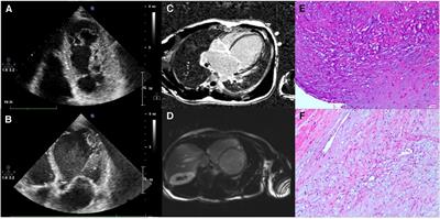 Case report: A new de novo mutation of the Troponin T2 gene in a Chinese patient with dilated cardiomyopathy